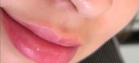 Revitalização Labial